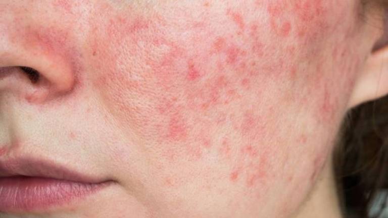 A rosácea é uma doença de pele comum, mas incurável, que afeta principalmente as áreas faciais