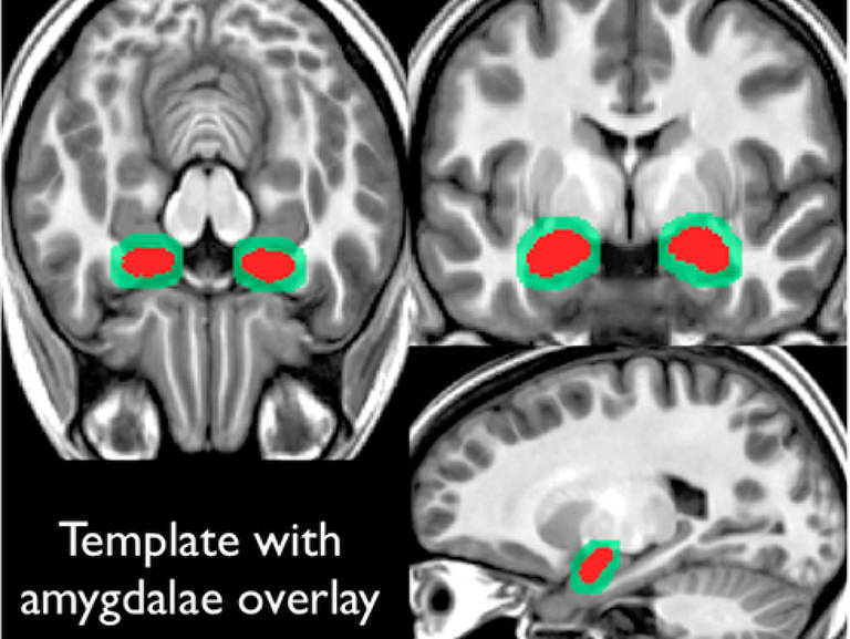 Ressonância magnética com amígdalas destacadas