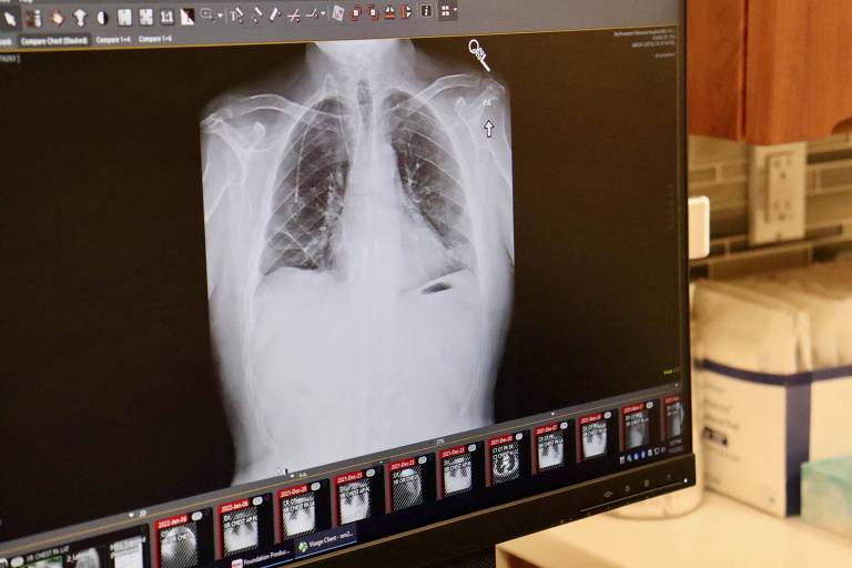 Imagem de raios-X dos novos pulmões de Albert Khoury, que foram transplantados para substituírem os pulmões que continham células cancerígenas
