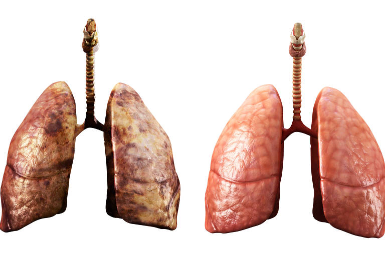 À esq., pulmão infectado com a bactéria da tuberculose. À dir., pulmão saudável