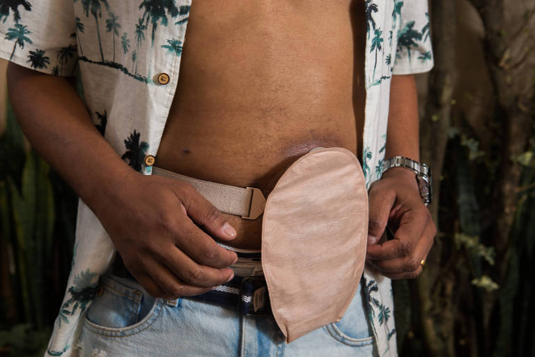 Homem negro com camisa tropical aberta mostra bolsa de ostomia bege anexada ao abdômen