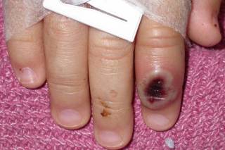 CDC PHOTO OF CHILDS INFECTED FINGER AFTER PARIRIE DOG BITE