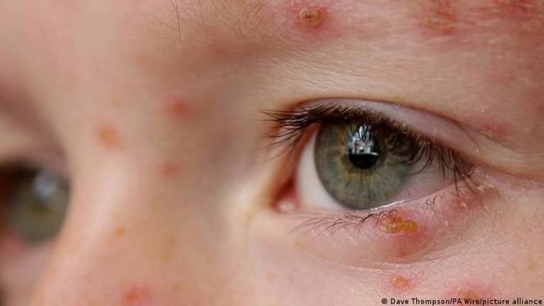 A catapora, com bolhas na pele que coçam muito, é provocada pelo varicela-zóster, um dos nove vírus de herpes conhecidos