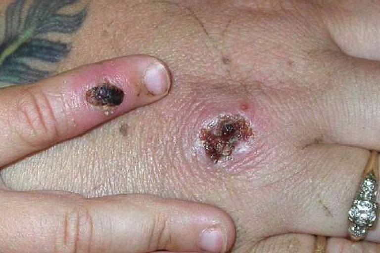 Imagem em close mostra a mão de uma pessoa com um machucado