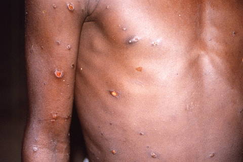 FILE PHOTO: An image created during an investigation into an outbreak of monkeypox, which took place in the Democratic Republic of the Congo, 1996 to 1997, shows the arms and torso of a patient with skin lesions due to monkeypox, in this undated image obtained by Reuters on May 18, 2022. CDC/Brian W.J. Mahy/Handout via REUTERS THIS IMAGE HAS BEEN SUPPLIED BY A THIRD PARTY./File Photo ORG XMIT: FW1