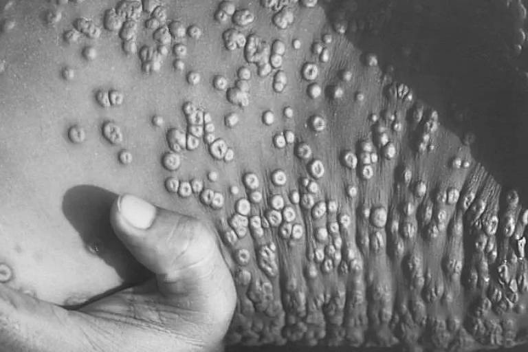 A varíola é uma das doenças mais mortas que já existiu