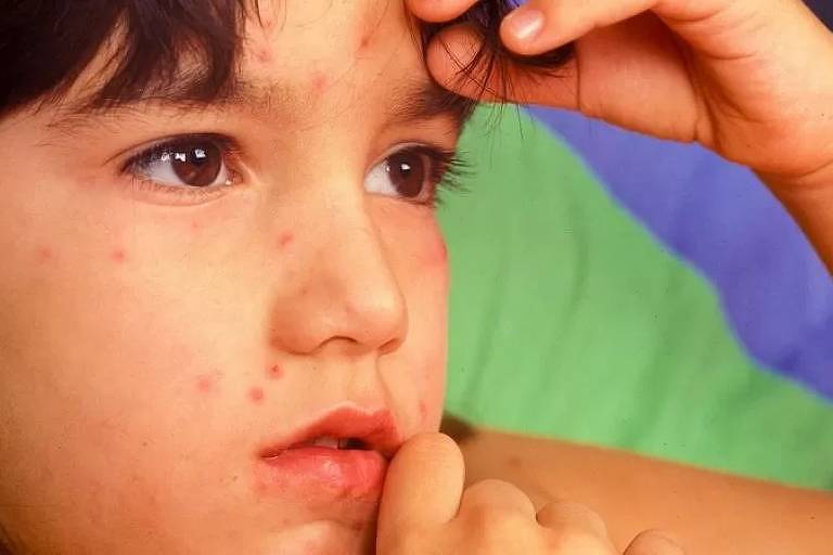 A varíola foi erradicada do mundo há 40 anos