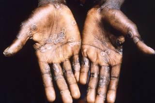 The palms of a monkeypox case patient from Lodja