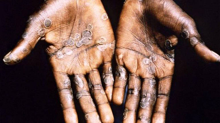 Pústulas características da varíola dos macacos em um paciente na República Democrática do Congo
