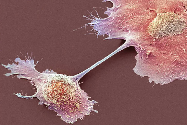 Combinação de radioterapia e drogas melhora ataque a tumor de pâncreas, aponta estudo