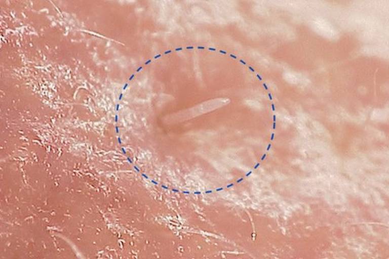 Imagem em close mostra ácaro em uma pele humana