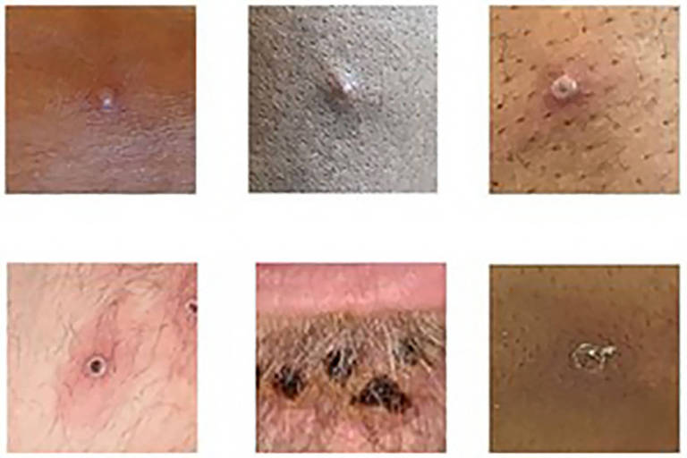 Imagens de feridas provocadas pela varíola dos macados