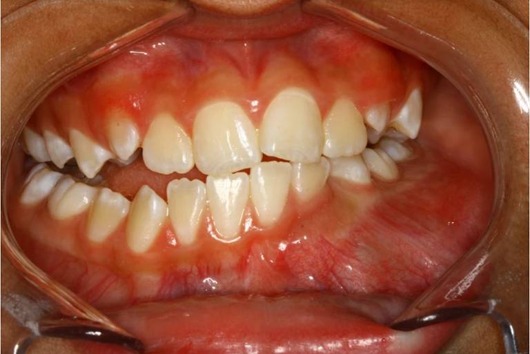 Casos de tumores na arcada dentária de crianças e adolescentes