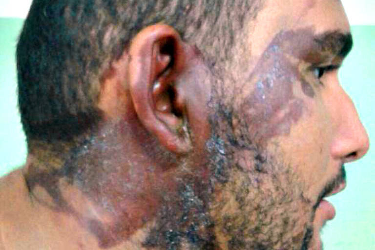 detalhe de cabeça de homem com queimaduras no rosto e ouvido
