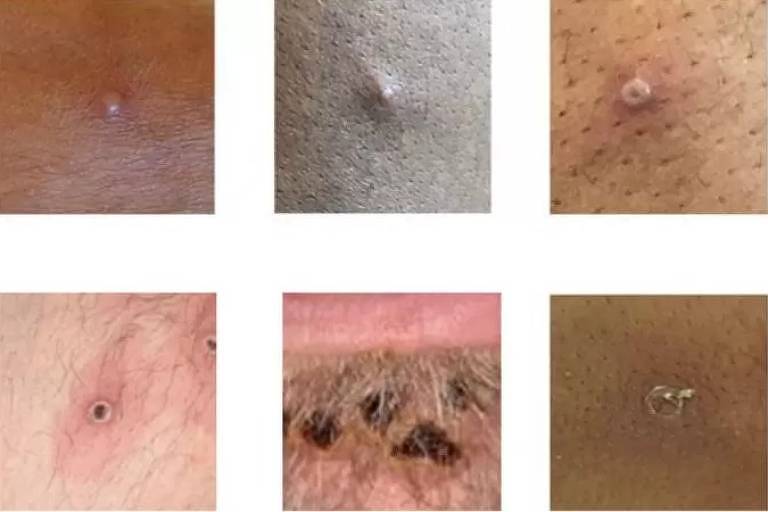 Alguns exemplos de lesões sugestivas de monkeypox