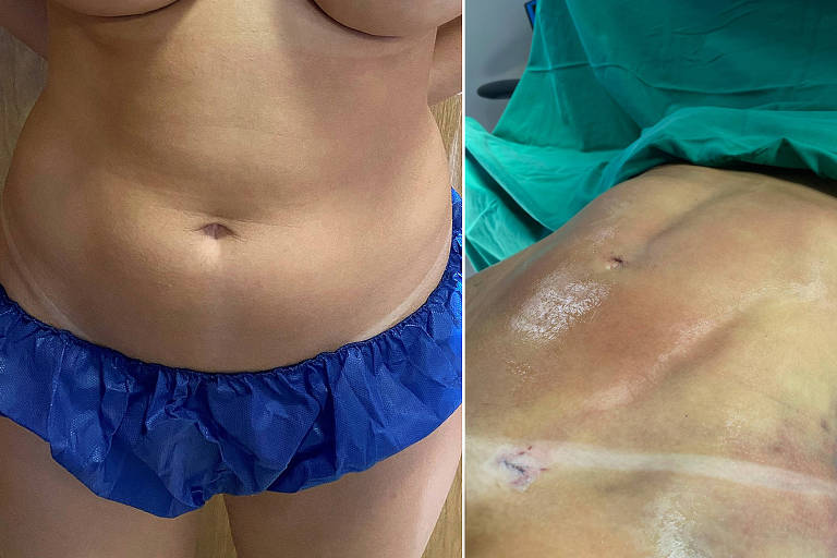 Lipo LAD custa até R$ 100 mil e constrói barriga de tanquinho na mesa de cirurgia