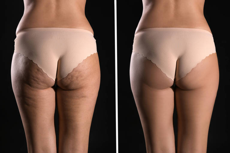 Montagem com fotos de mulher antes e depois do tratamento anti-celulite em fundo preto