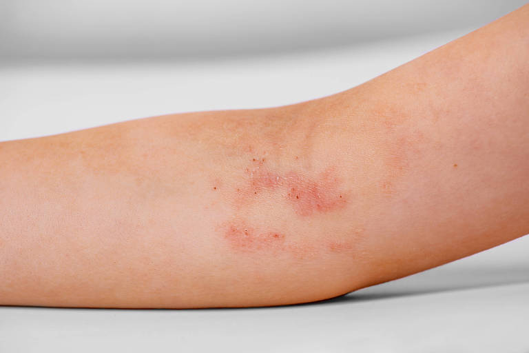 Braço de uma criança com dermatite atópica