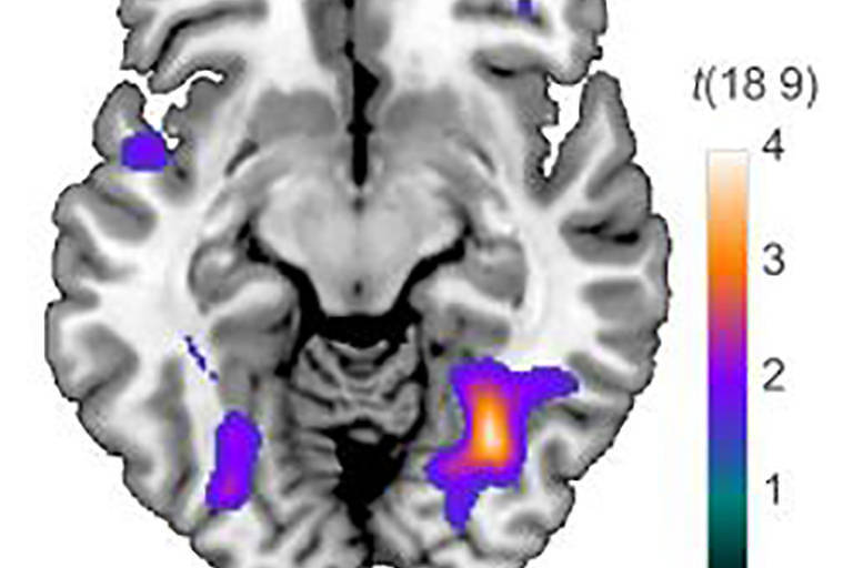 Imagem mostra ativação de áreas do cérebro após visualização de foto de rosto
