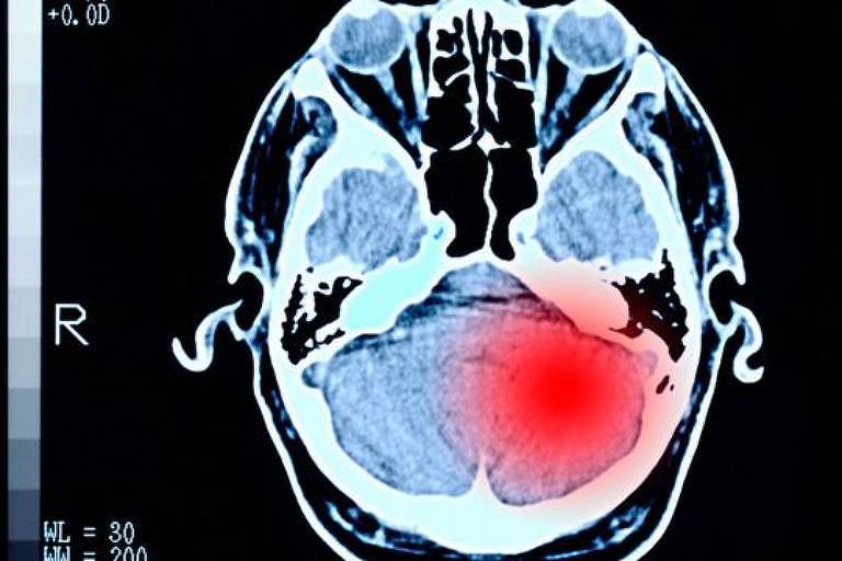 'Os tumores cerebrais são um desafio porque as possibilidades de tratamento e o prognóstico de recuperação são extremamente ruins', diz especialista