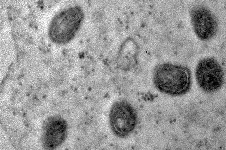 RJ confirma morte de homem por varíola dos macacos, 2º óbito no Brasil