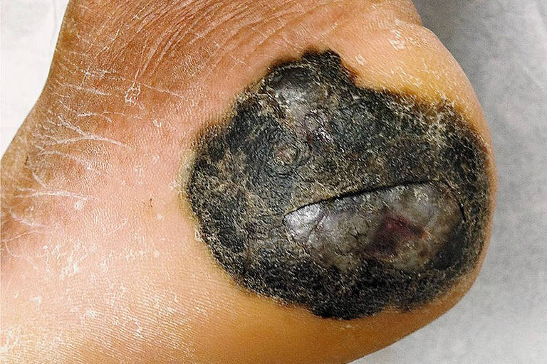 Melanoma Acral, um tipo de câncer de pele que ocorre mais em negros.