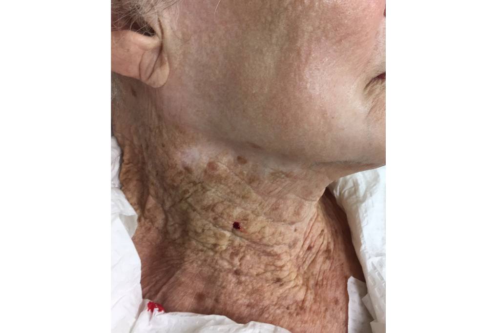 Artigo mostra idosa que usou protetor apenas no rosto - 06/09/2022 -  Equilíbrio - Folha