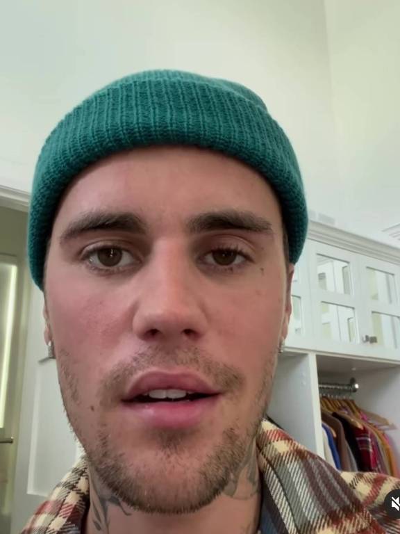 Justin Bieber mostra rosto  parcialmente paralisado por doença rara