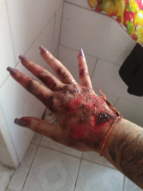 Foto da mão de uma mulher com vários ferimentos
