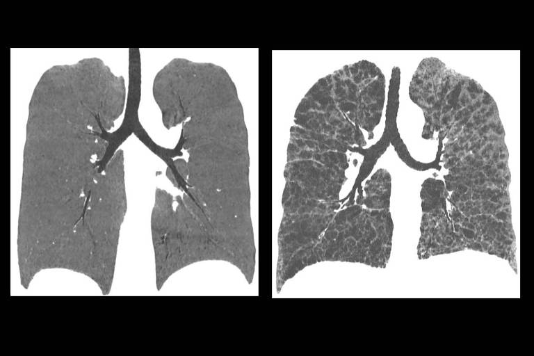 Tomografias mostram pulmão normal ( à esq.) e com extenso enfisema