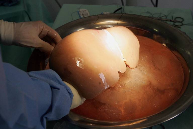Médico segura um fígado durante transplante