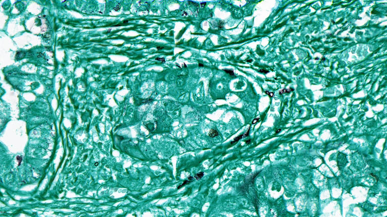 Imagem microscópica de um tumor pulmonar, que se assemelha a um borrão de tinta verde, com pontinhos pretos espalhados.