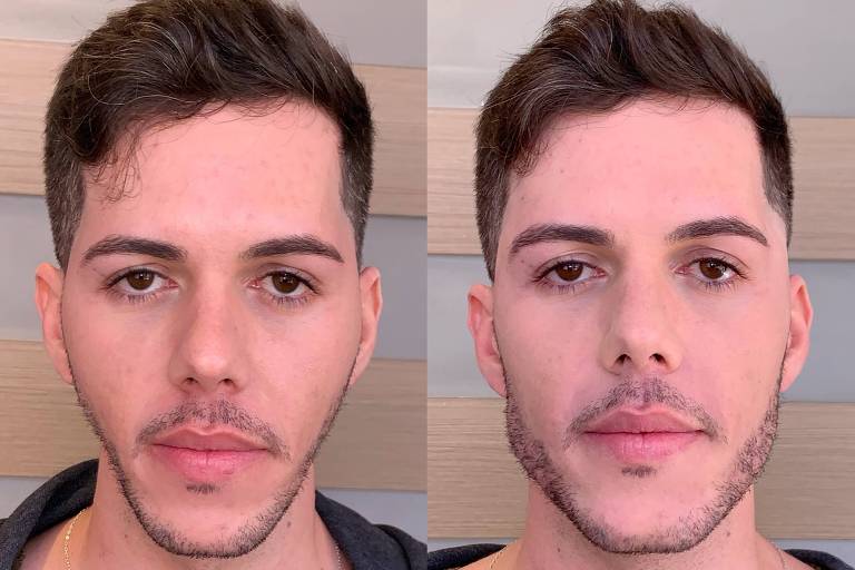 O antes e depois da harmonização facial do cirurgião-dentista Fábio Rafael, 30