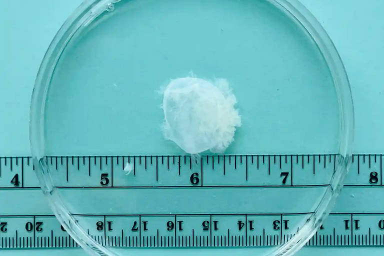 Material coletado em aborto após sete semanas de gestação