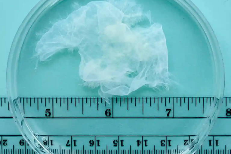 Material coletado em aborto após oito semanas de gestação