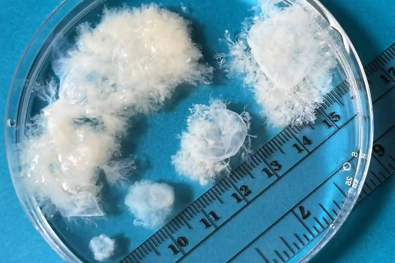 Coletas de aborto mostram os materiais de cinco a nove semanas de gestação