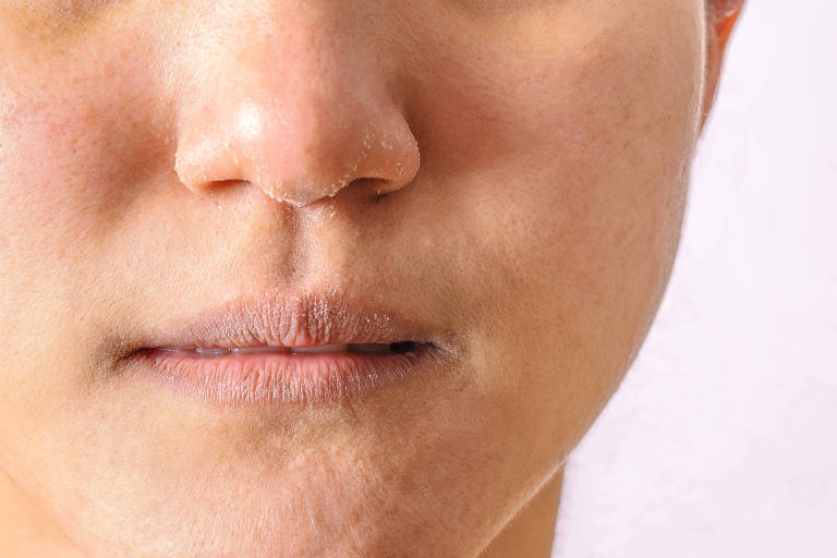 Seis dicas de uma dermatologista para evitar o ressecamento da pele