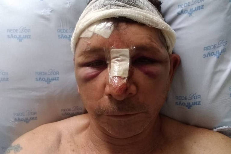 Homem é atingido por pedra que se soltou de viaduto no ABC e tem o nariz quebrado