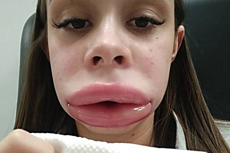 Jovem branca mostra lábios inchados após procedimento