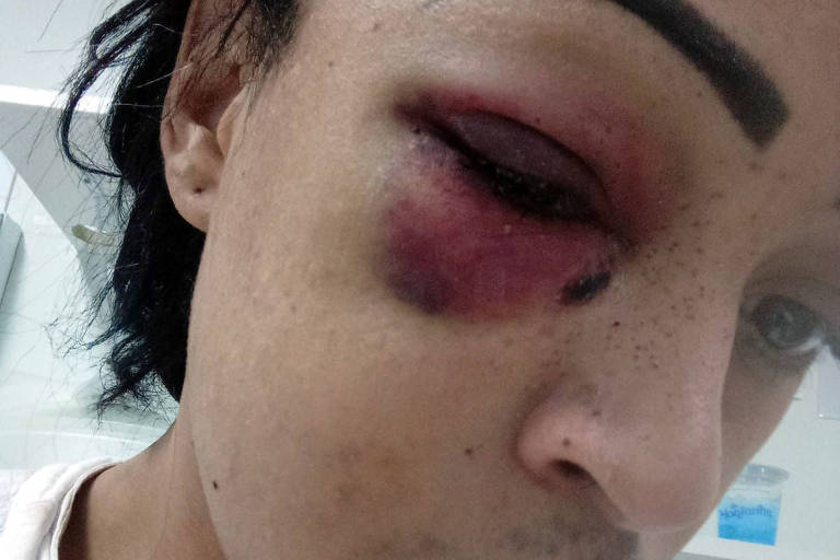 Mulher trans fica com bala alojada no rosto após ser atacada em Niterói (RJ)