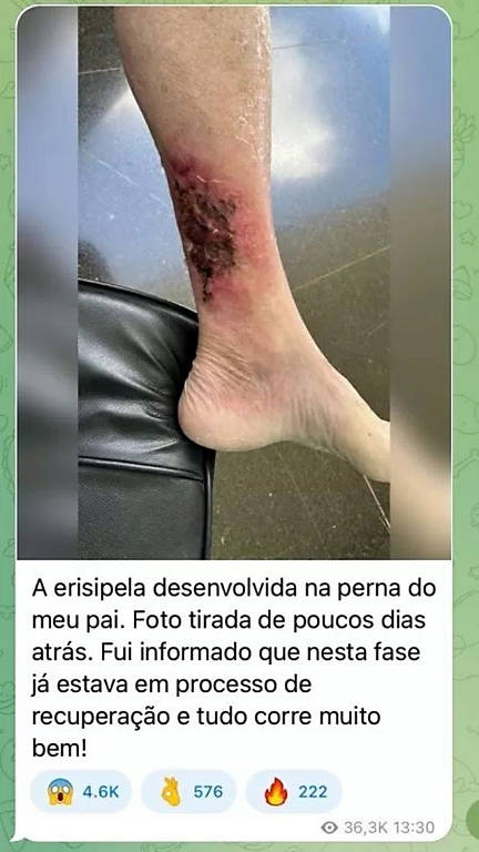 Erisipela: entenda infecção na perna que afeta Bolsonaro