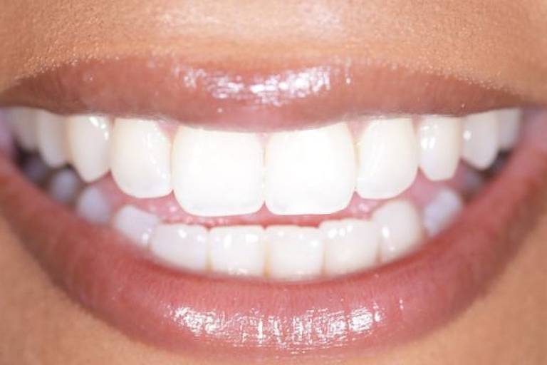 Foto horizontal bem fechada no sorriso de boca que parece ser de mulher de pele morena. Dentes bem brancos e alinhados.