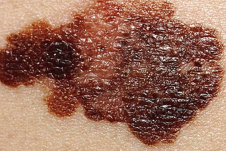 Saber identificar quando uma mancha pode indicar câncer de pele é importante para o diagnóstico precoce