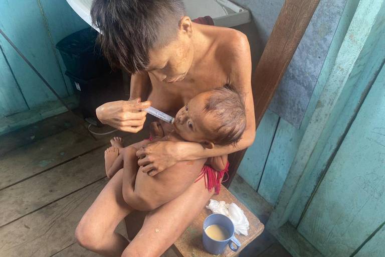 Crianças yanomamis desnutridas e com doenças como verminoses