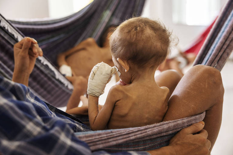 Crianças yanomamis são intubadas em UTI de Boa Vista com desnutrição grave e longe dos pais