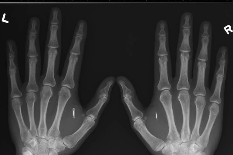 Raio-x de duas mãos espalmadas vistas de cima. Ambas possuem, entre os ossos do polegar e do indicador, uma pequena mancha branca
