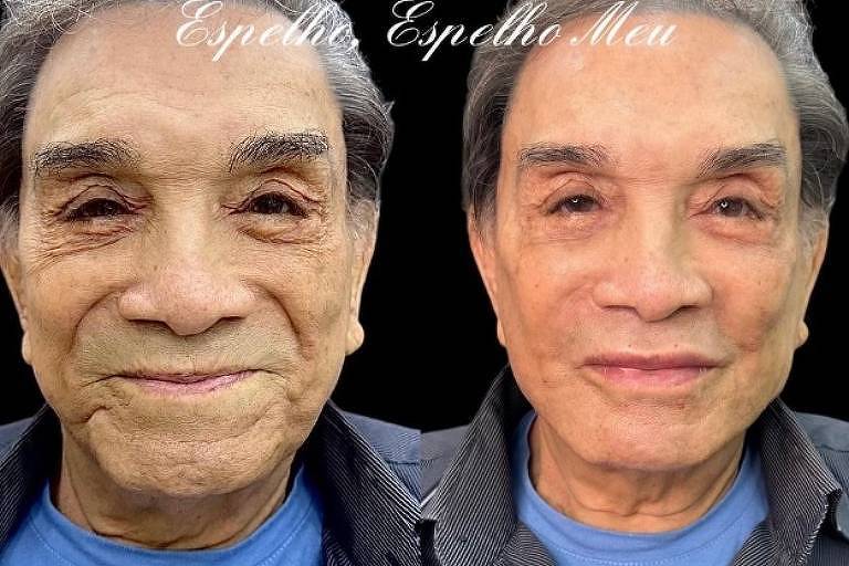 Em foto colorida, homem mostra o antes e o depois de uma harmonização facial