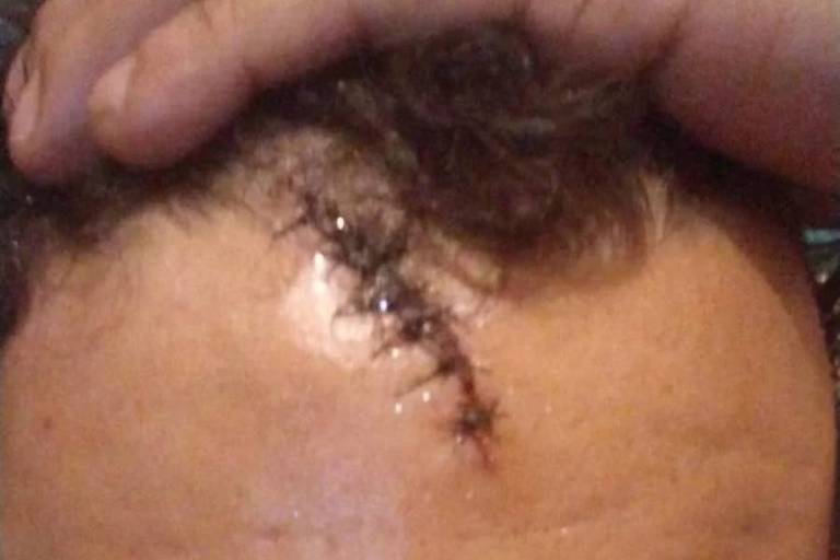 Designer mostra pontos na testa após dizer ter sido agredido por guarda-civil municipal