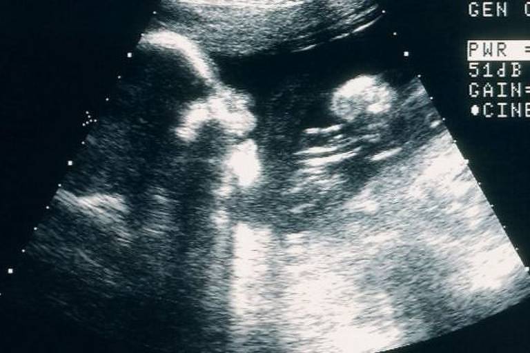 Contornos de bebê em exame de ultrassom