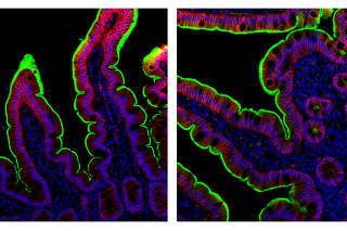 An undated combination photo provided by Minami Tokuyama//MehandruLab at the Icahn School of Medicine at Mount Sinai shows ACE2, the receptor for SARS-CoV-2 (the virus that causes Covid-19), shown in green, with intestinal epithelial cells in red and cell